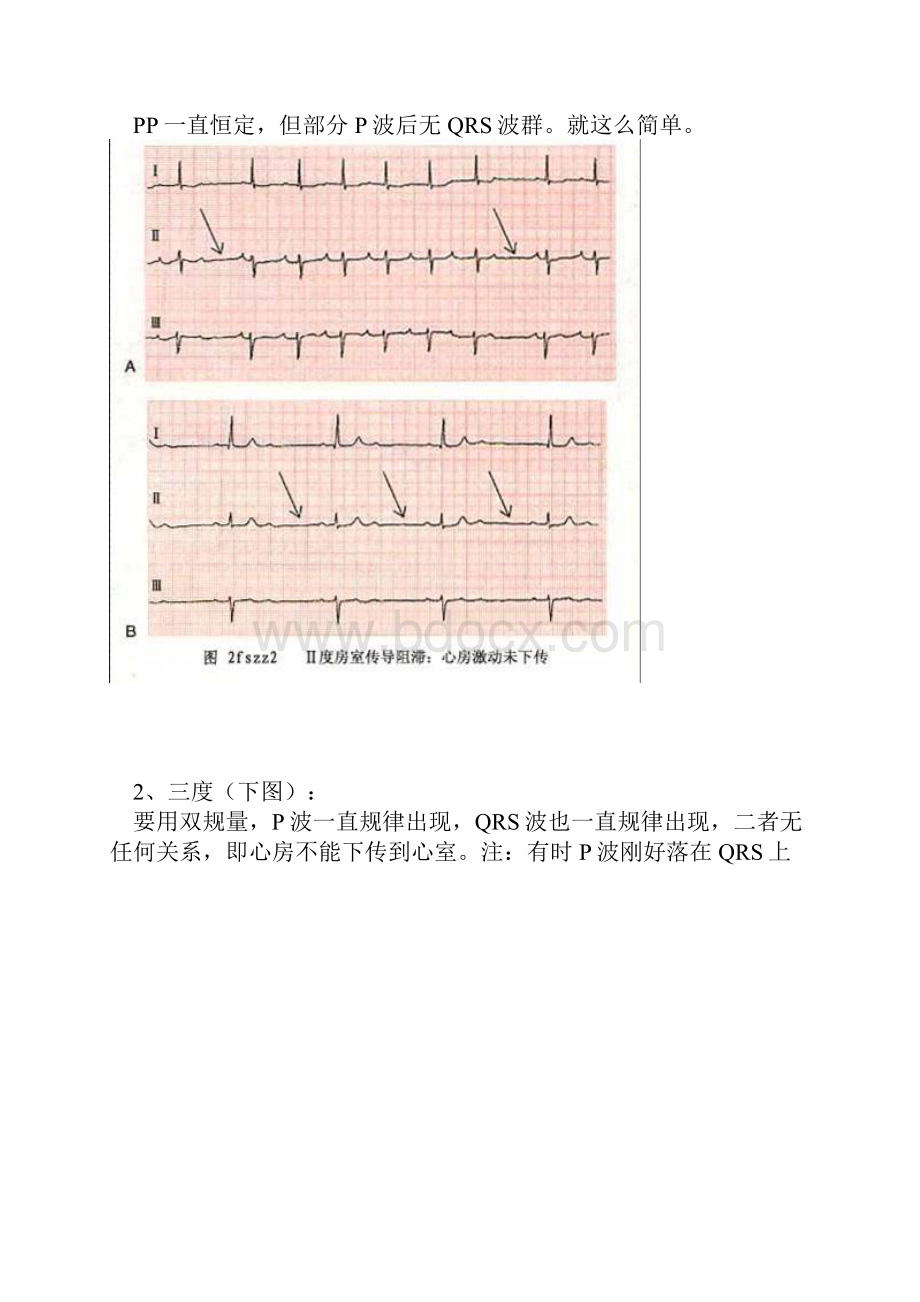 心电图 原来也可以这么简单 看看吧Word下载.docx_第3页