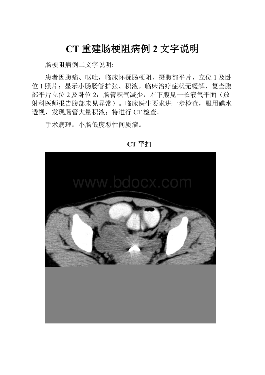 CT重建肠梗阻病例2文字说明.docx