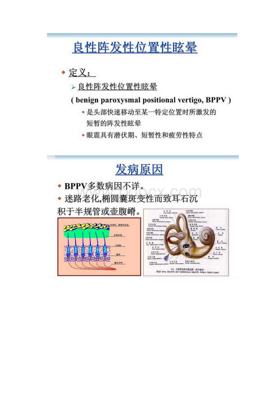 良性阵发性位置性眩晕的诊断与治疗.docx_第3页