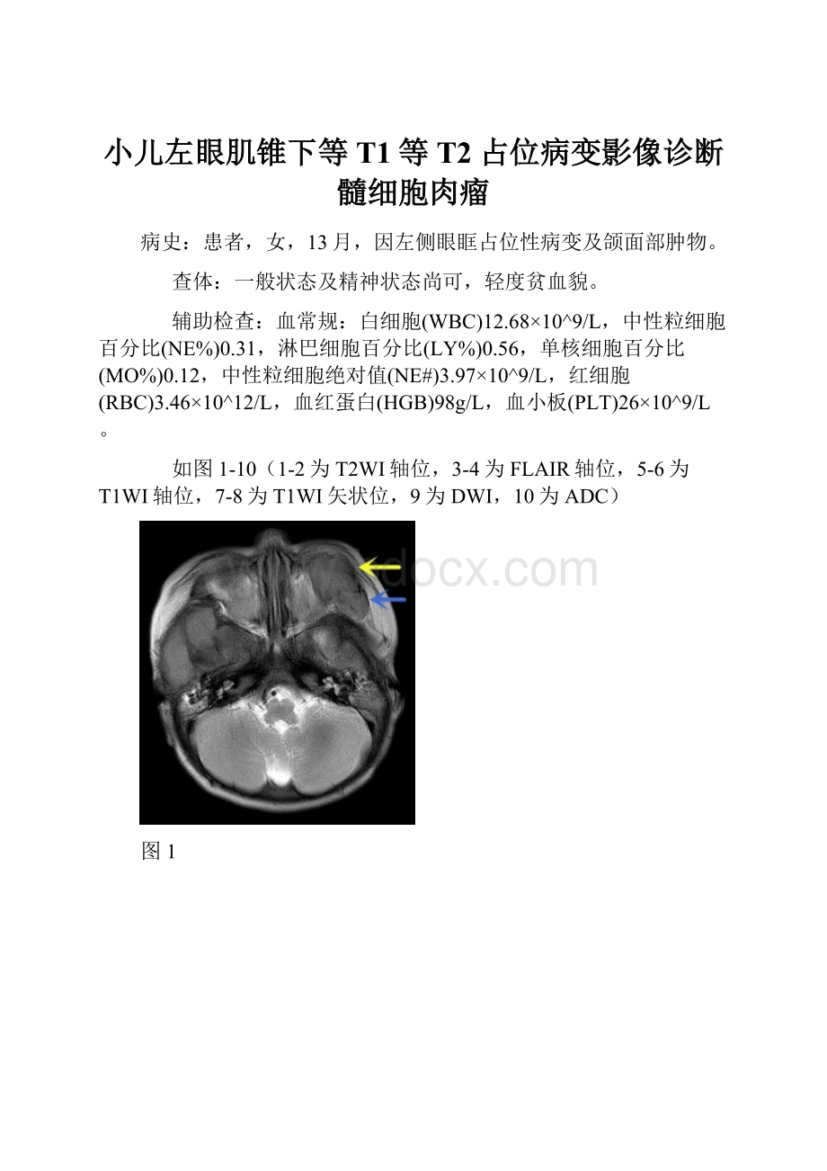 小儿左眼肌锥下等T1等T2占位病变影像诊断髓细胞肉瘤.docx