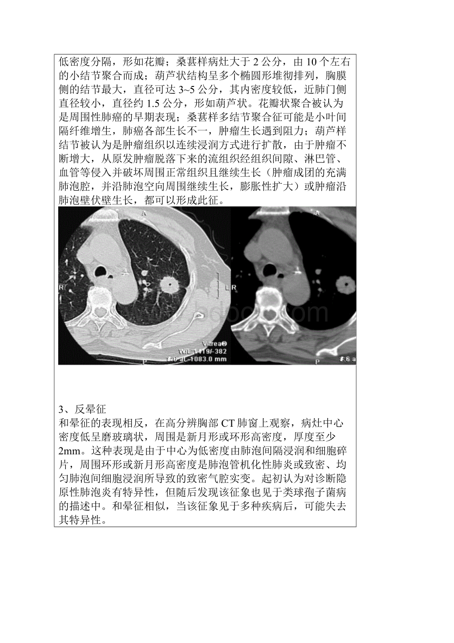 胸部医学影像征象集萃 图片.docx_第2页