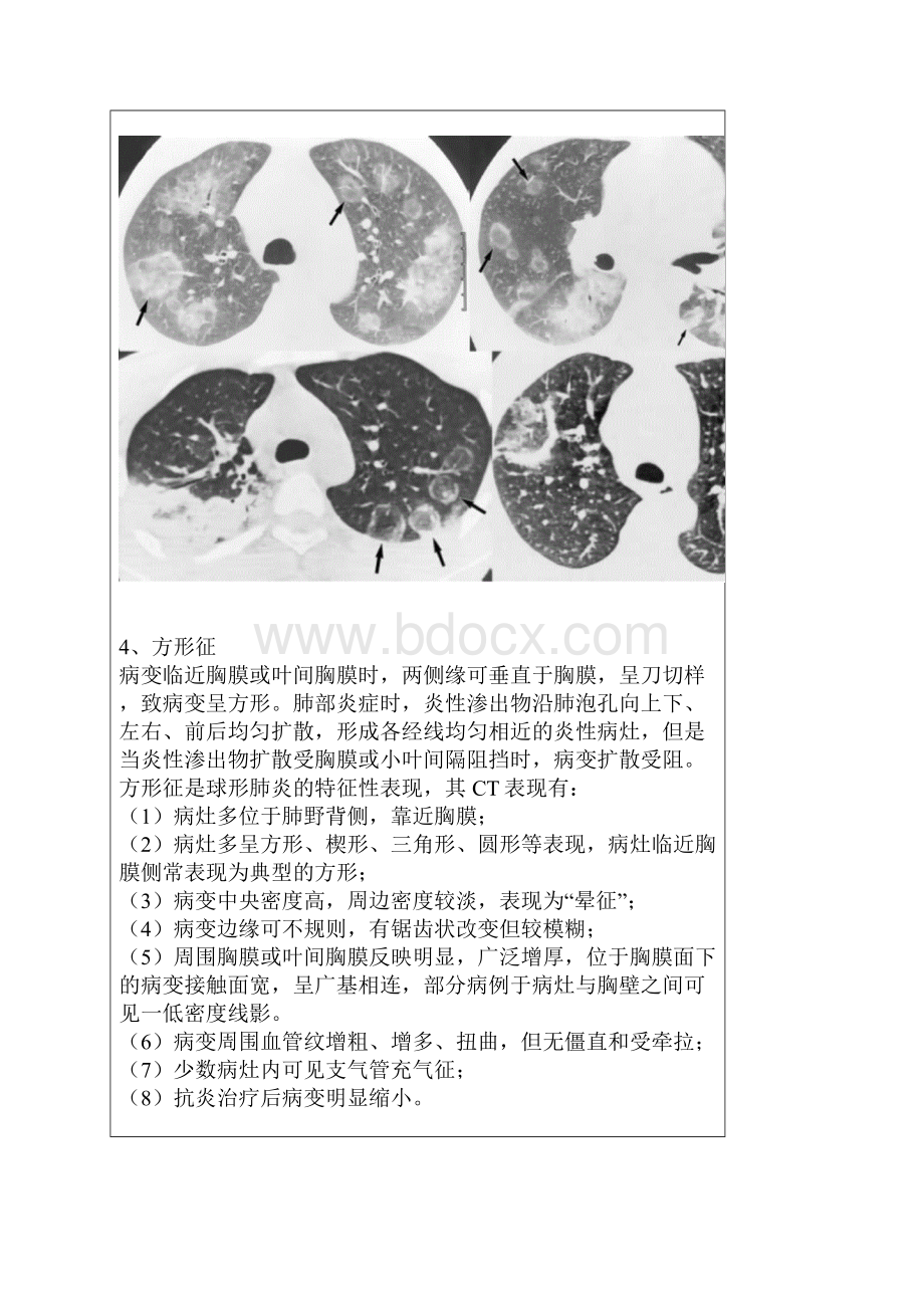 胸部医学影像征象集萃 图片.docx_第3页