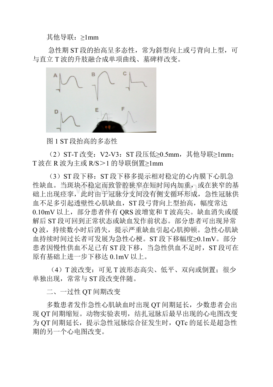 心肌缺血心电图分析.docx_第2页