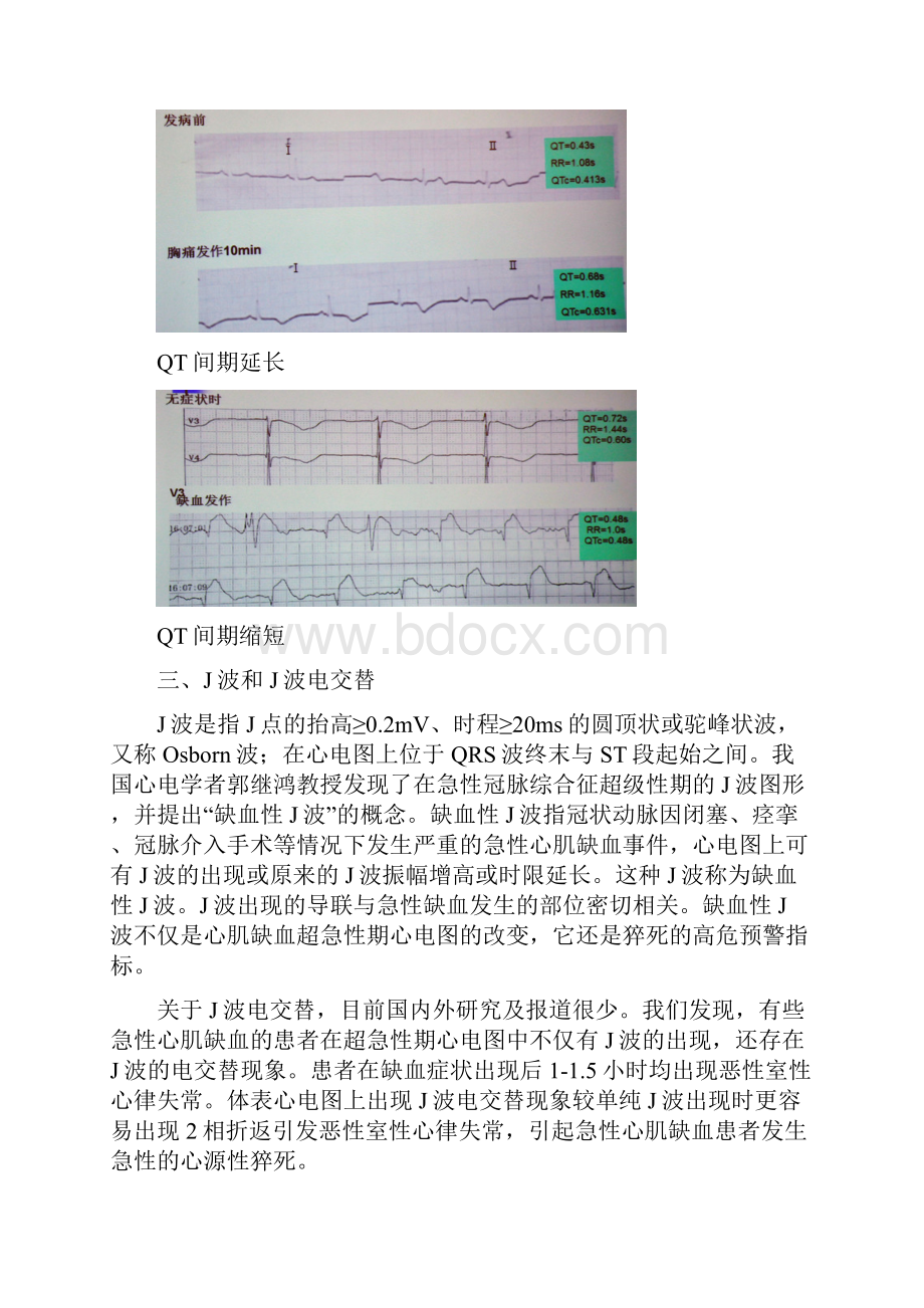 心肌缺血心电图分析.docx_第3页