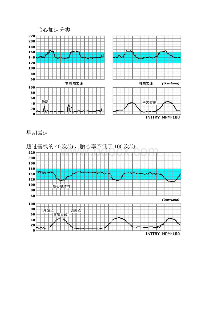 胎心监护图谱.docx_第2页