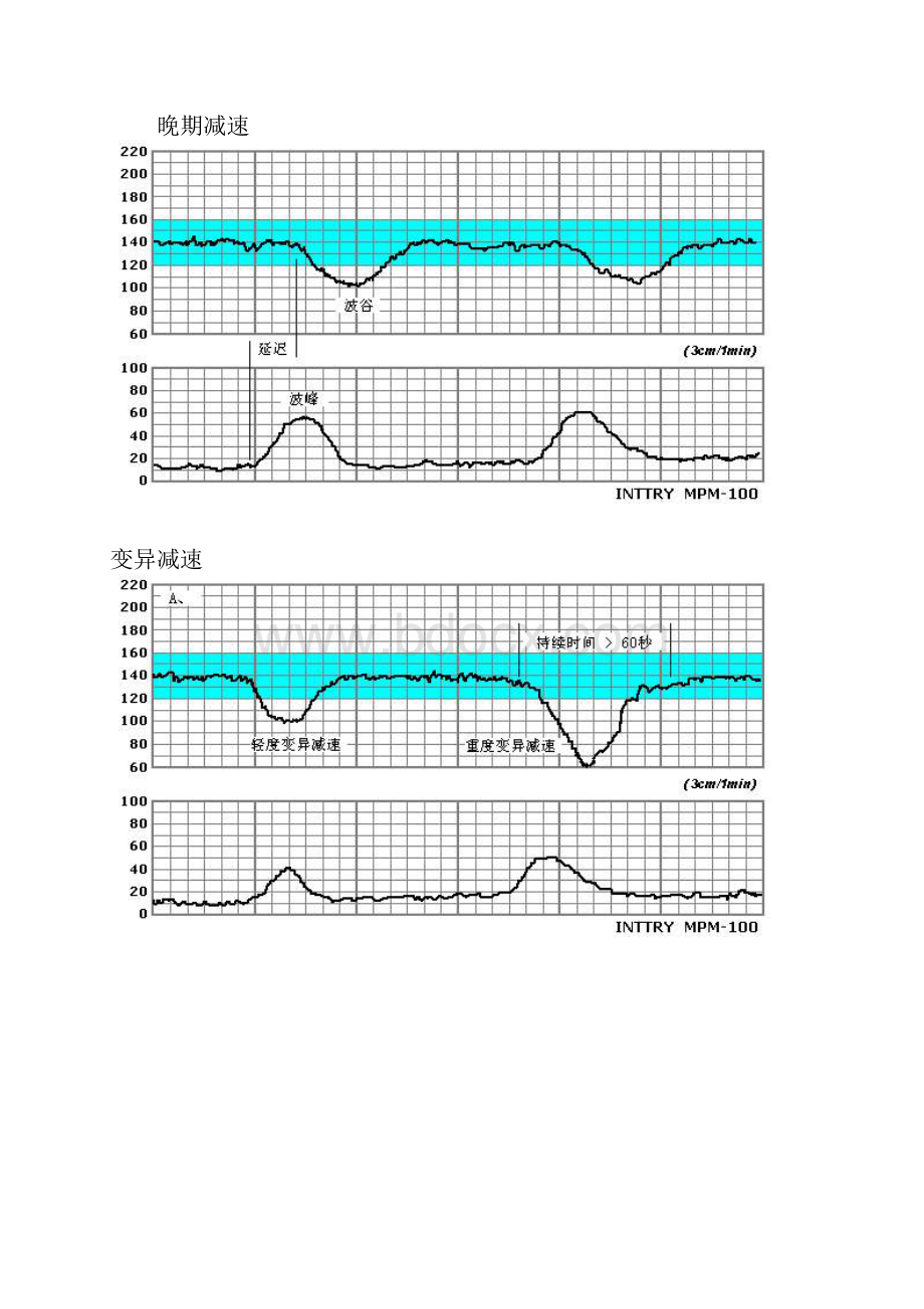 胎心监护图谱.docx_第3页