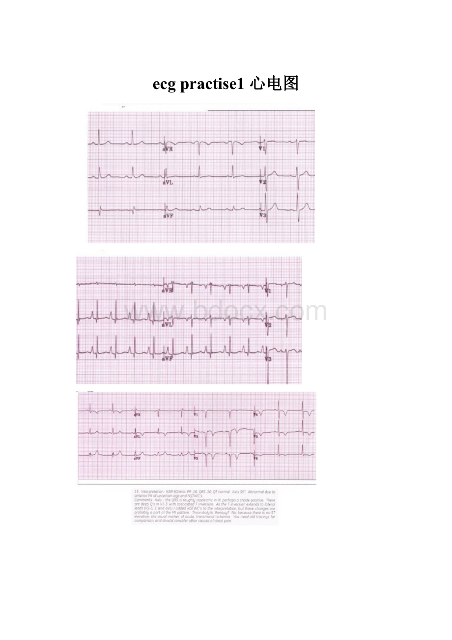 ecg practise1 心电图.docx_第1页