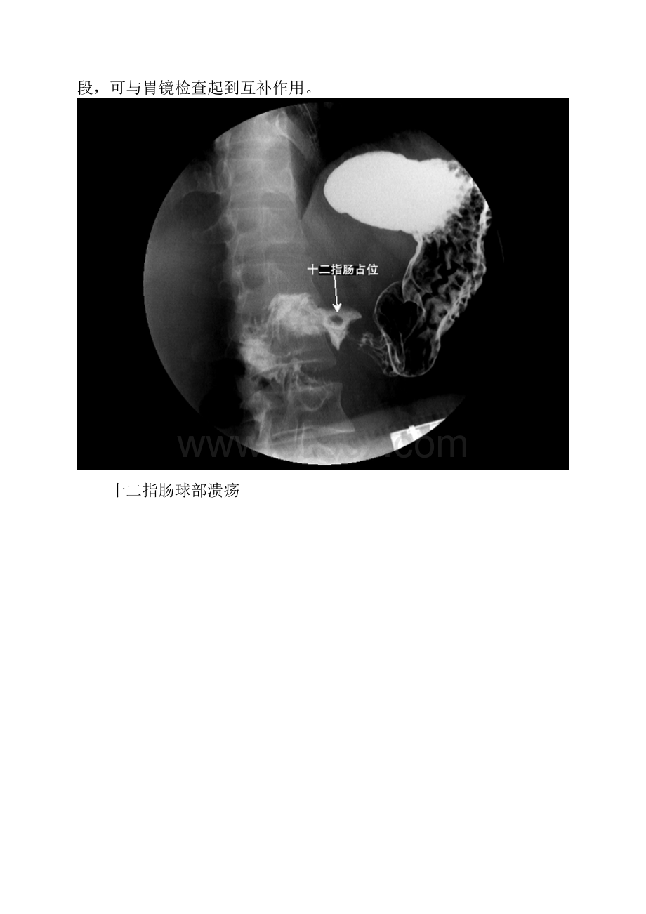 分钟读懂消化道造影片肠篇.docx_第2页