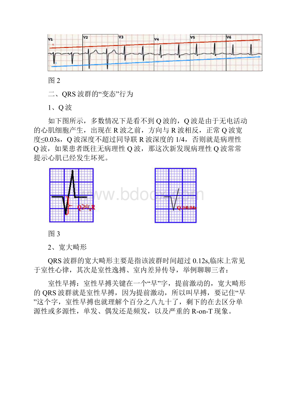 心电图QRS波群的五种.docx_第3页