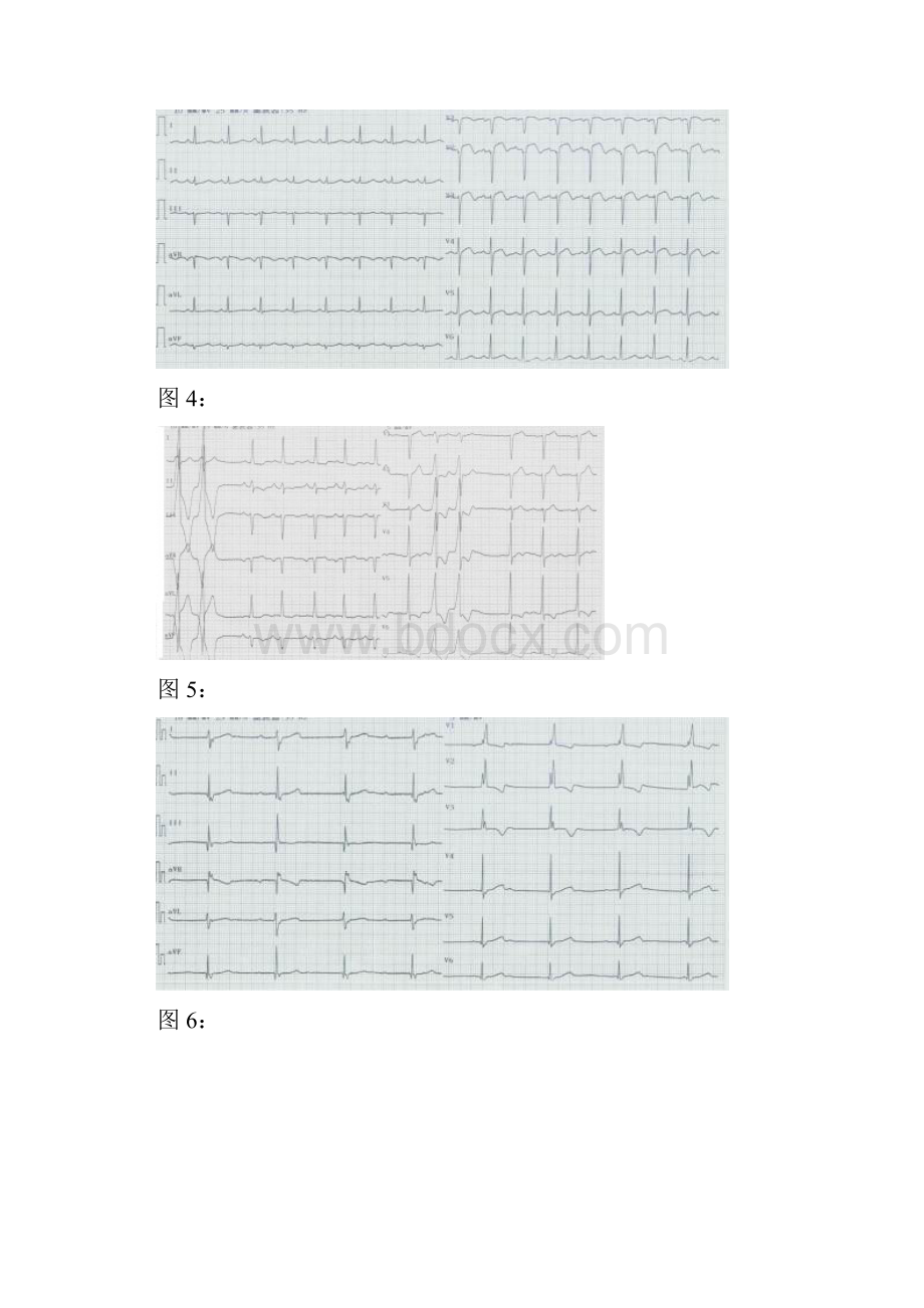 心电图阅图精彩试题14题及问题详解.docx_第2页