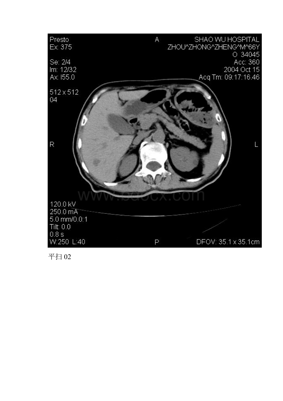 肝海绵状血管瘤CT02.docx_第2页