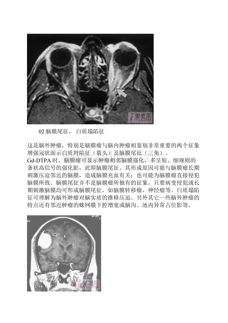 影像学各种征象综合.docx_第2页