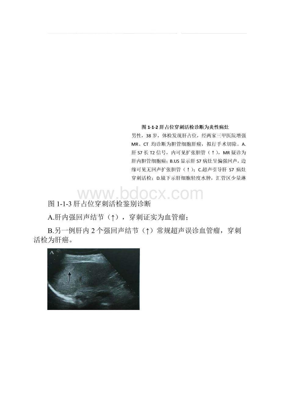 肝占位性病变超声引导下穿刺活检.docx_第3页