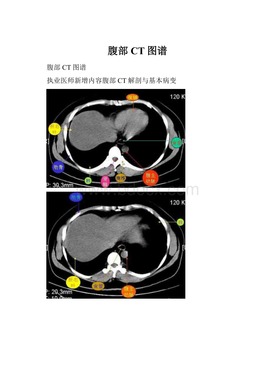 腹部CT图谱.docx