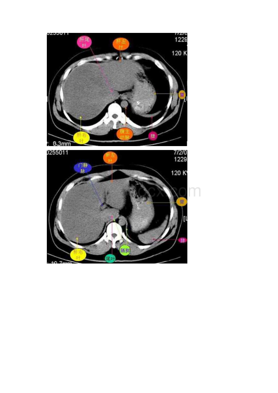 腹部CT图谱.docx_第2页
