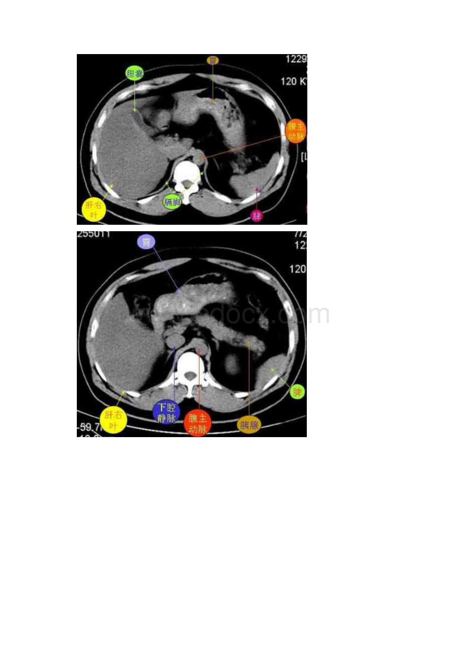 腹部CT图谱.docx_第3页
