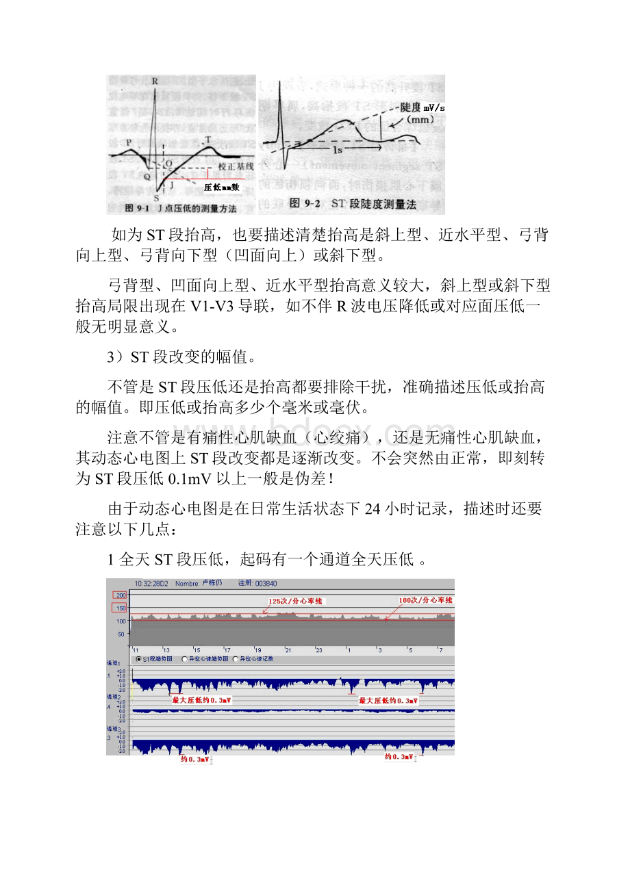 另类心电图讲义17动态心电图2.docx_第2页