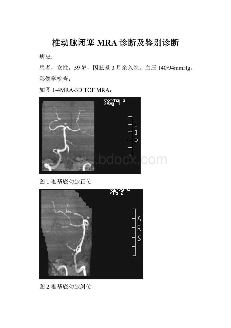 椎动脉闭塞MRA诊断及鉴别诊断.docx