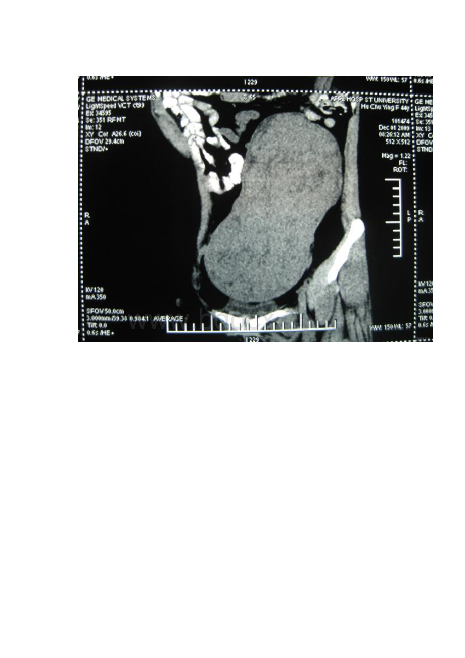 腹部庞大包块子宫肌瘤.docx_第3页