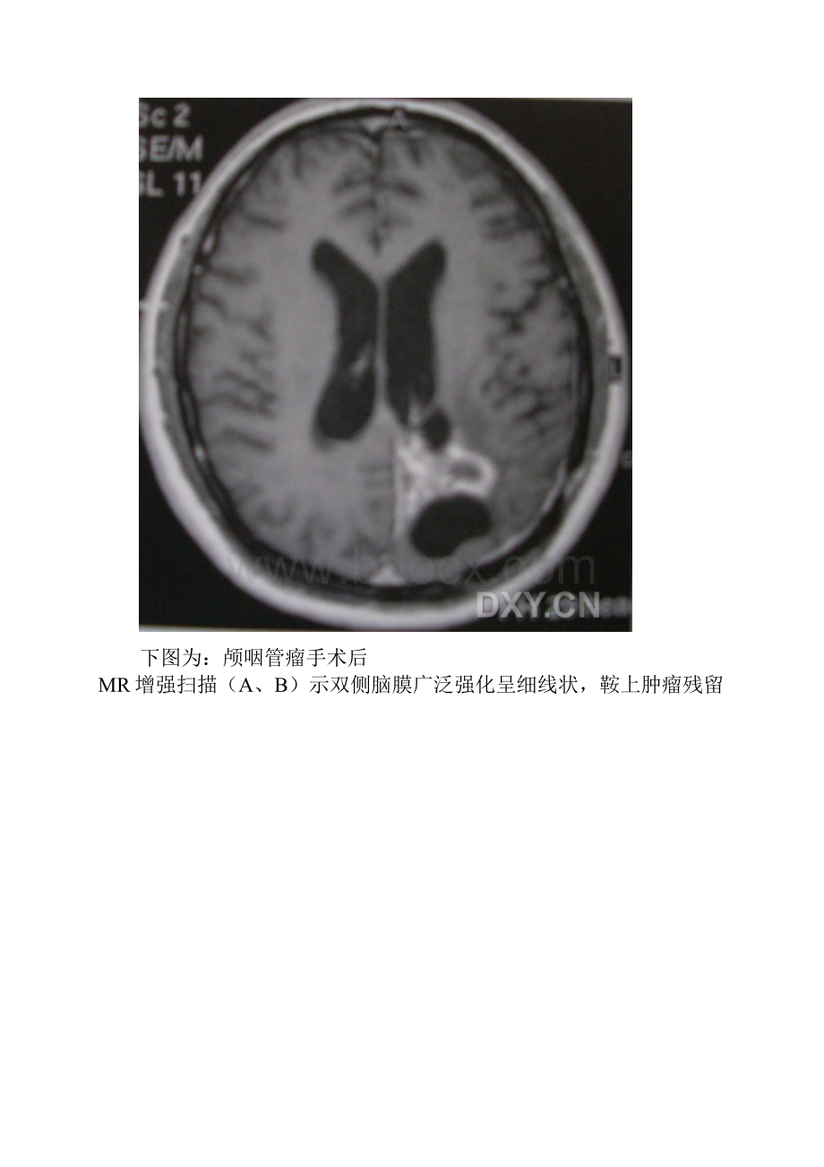 MRI影像脑膜强化疾病.docx_第3页