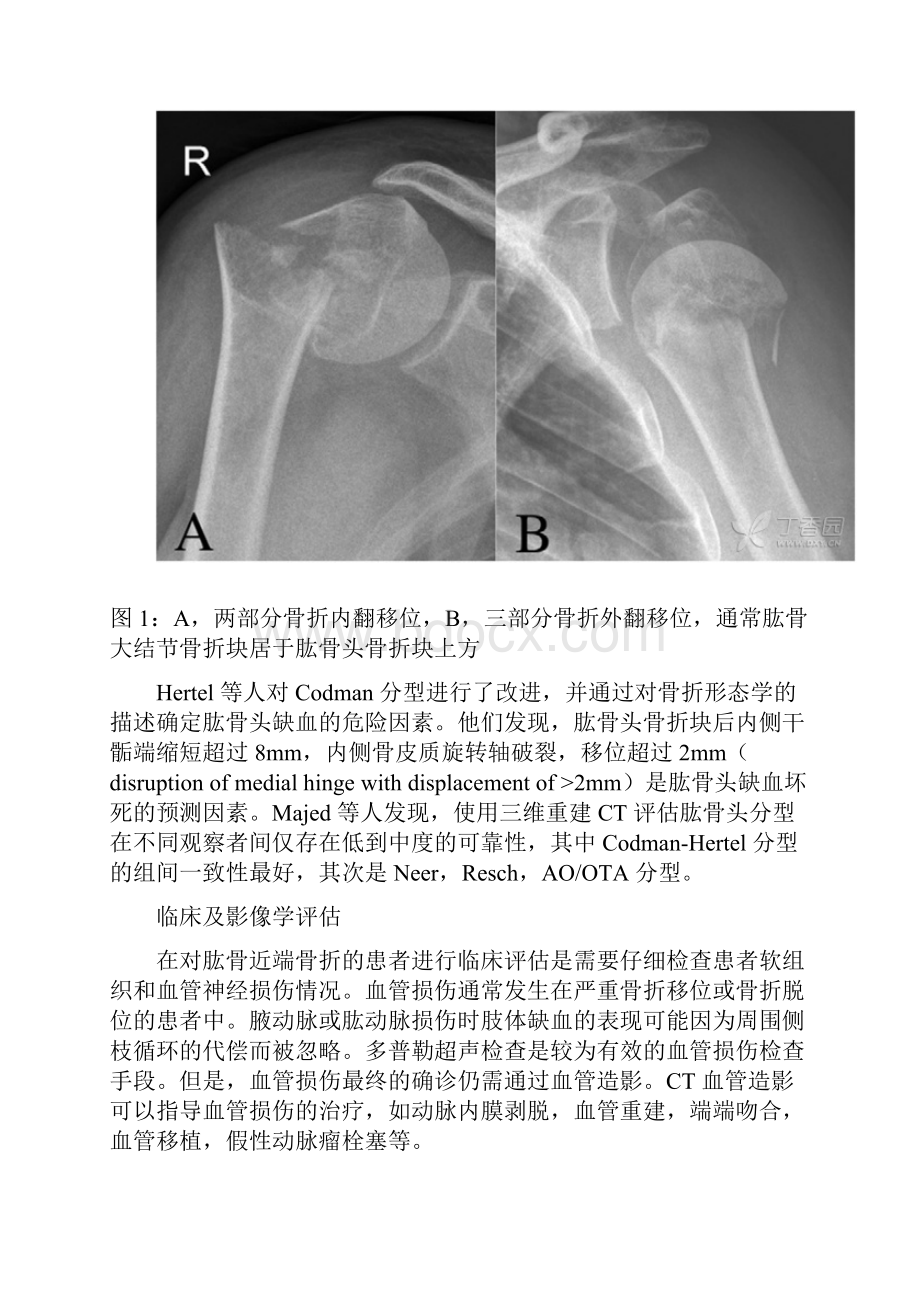 成人肱骨近端骨折治疗.docx_第3页