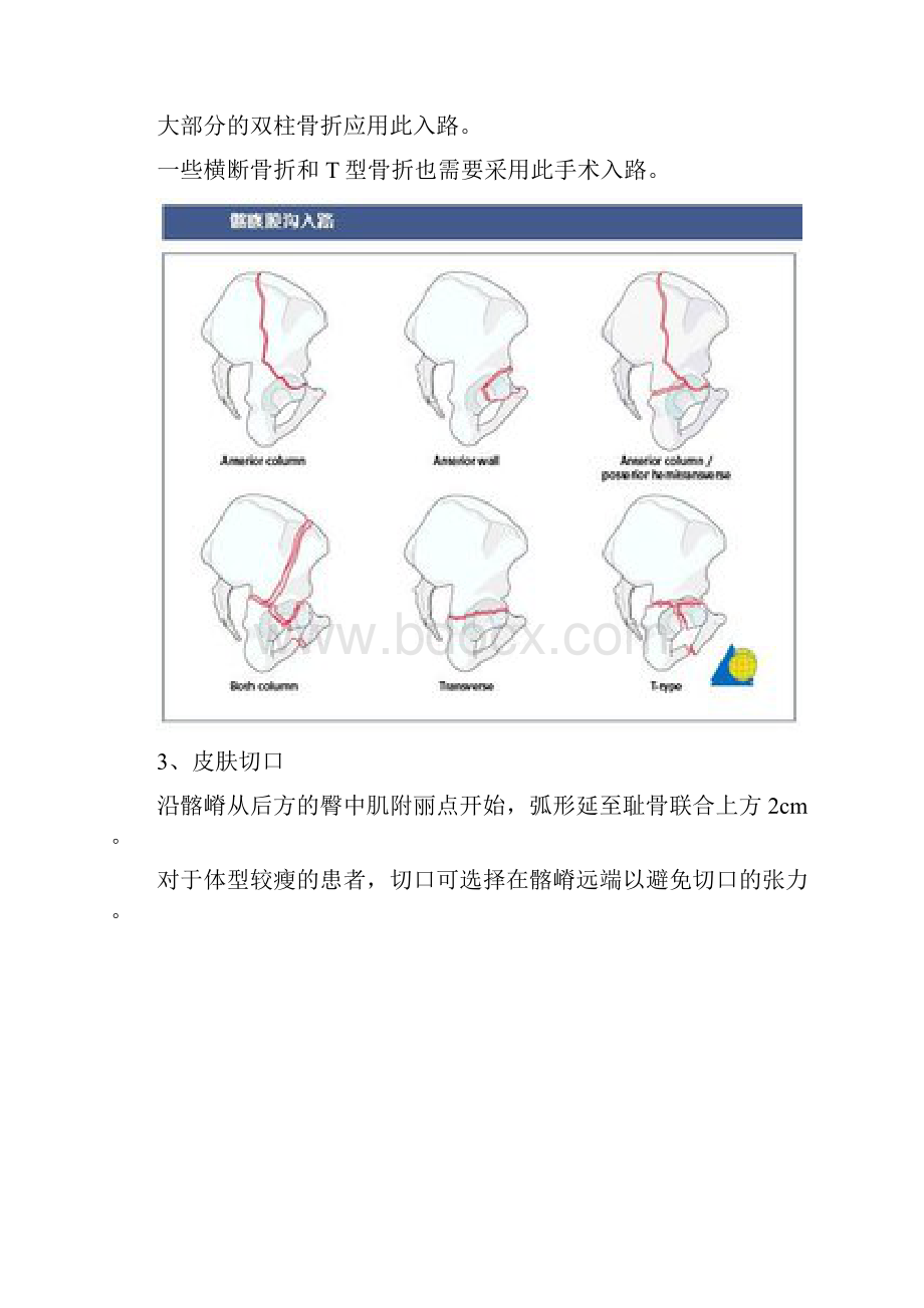 髂腹股沟入路解剖.docx_第2页