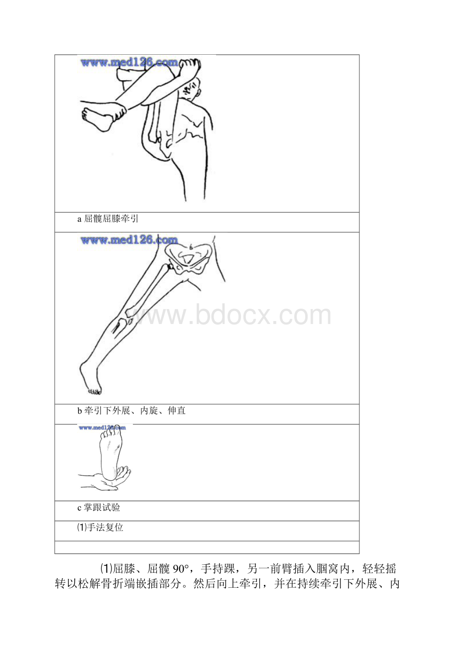 股骨颈骨折复位内固定术.docx_第3页