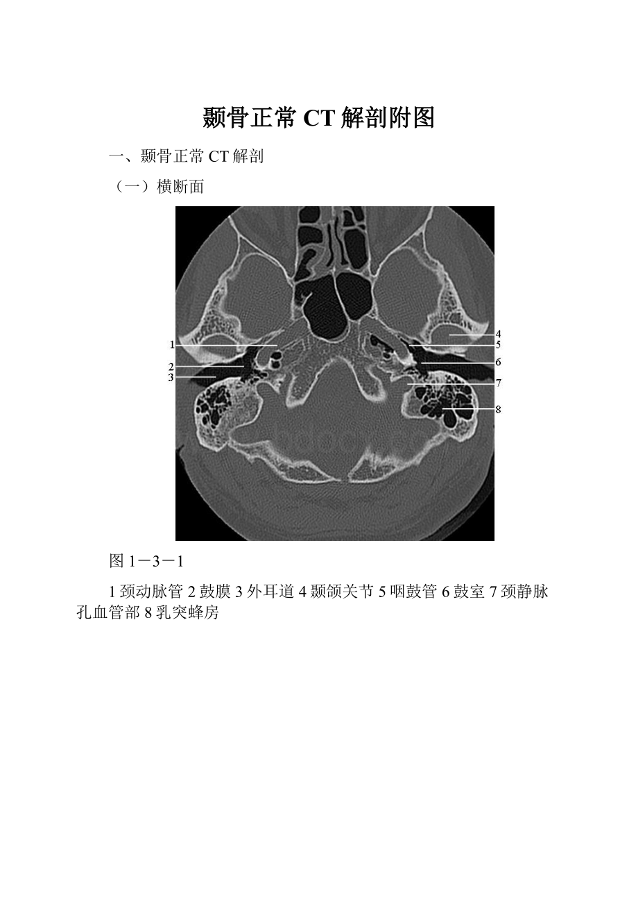 颞骨正常CT解剖附图.docx_第1页