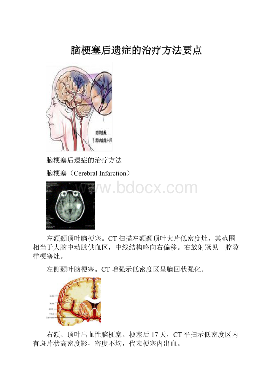 脑梗塞后遗症的治疗方法要点.docx