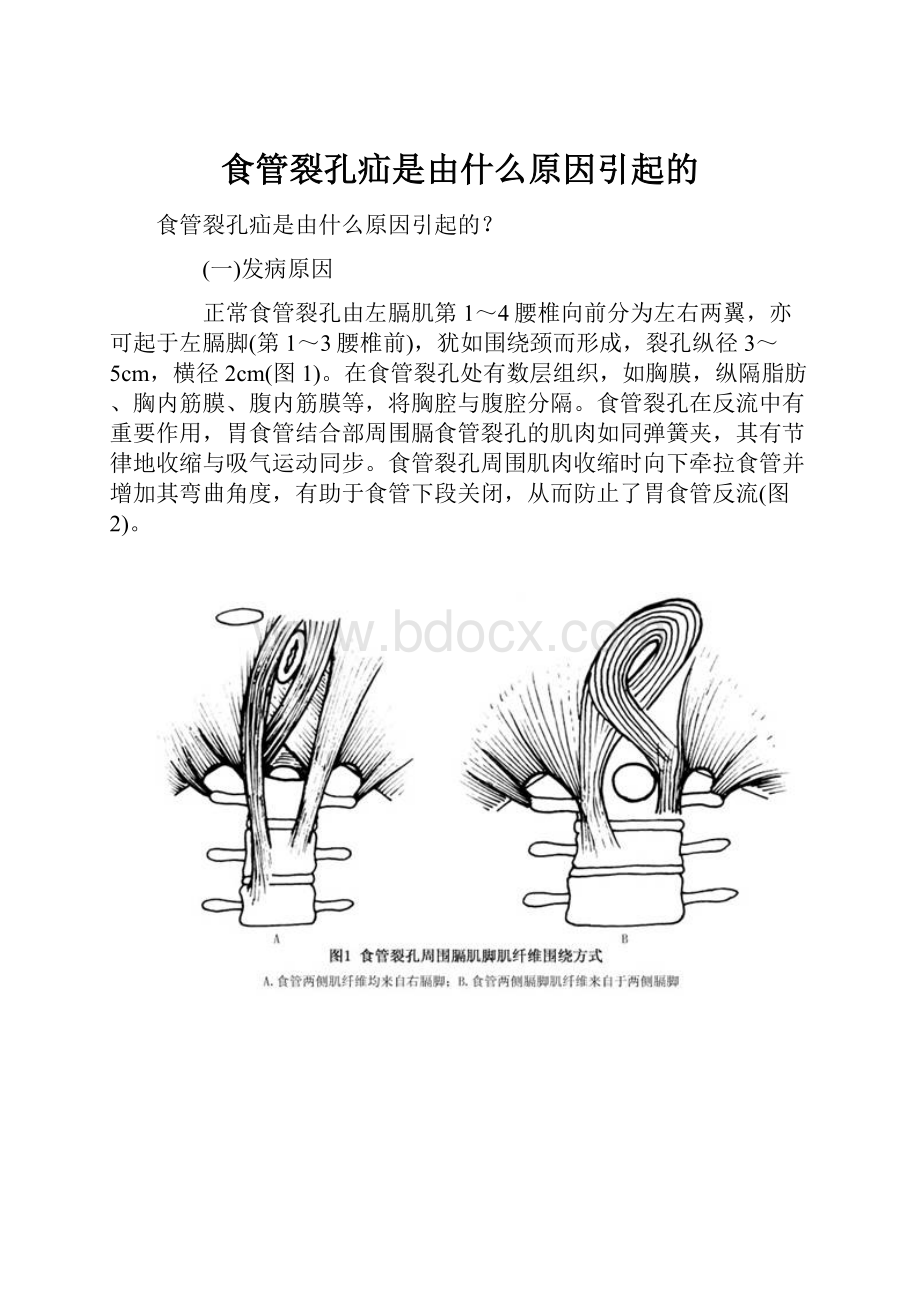 食管裂孔疝是由什么原因引起的.docx_第1页