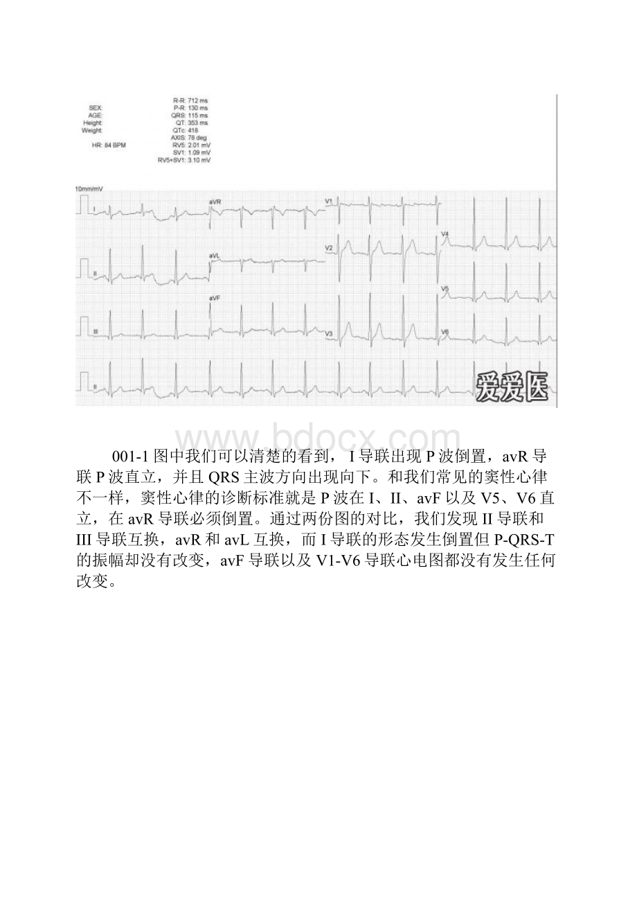 左右手反接和镜像性右位心.docx_第2页