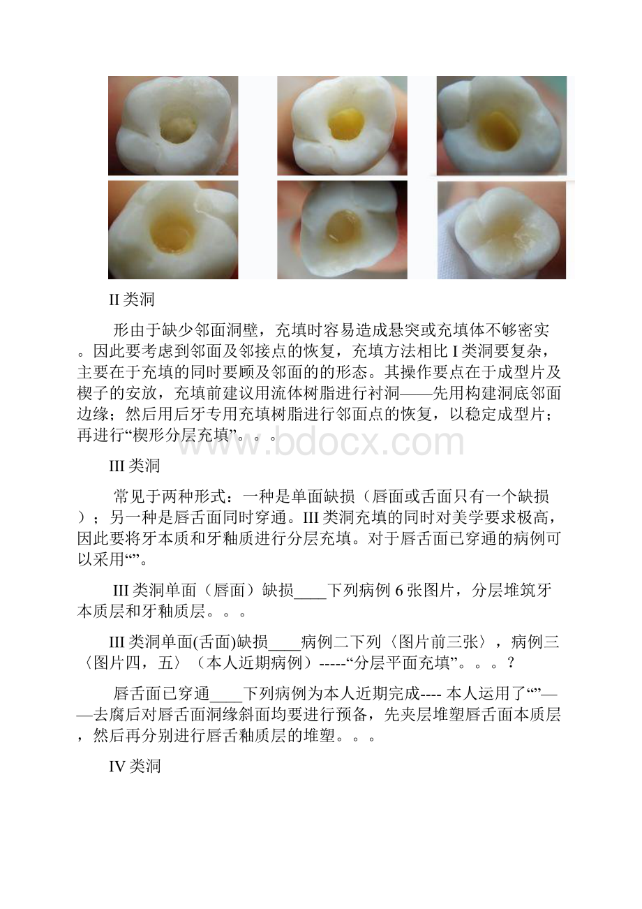 图解各类洞形树脂充填方法.docx_第2页