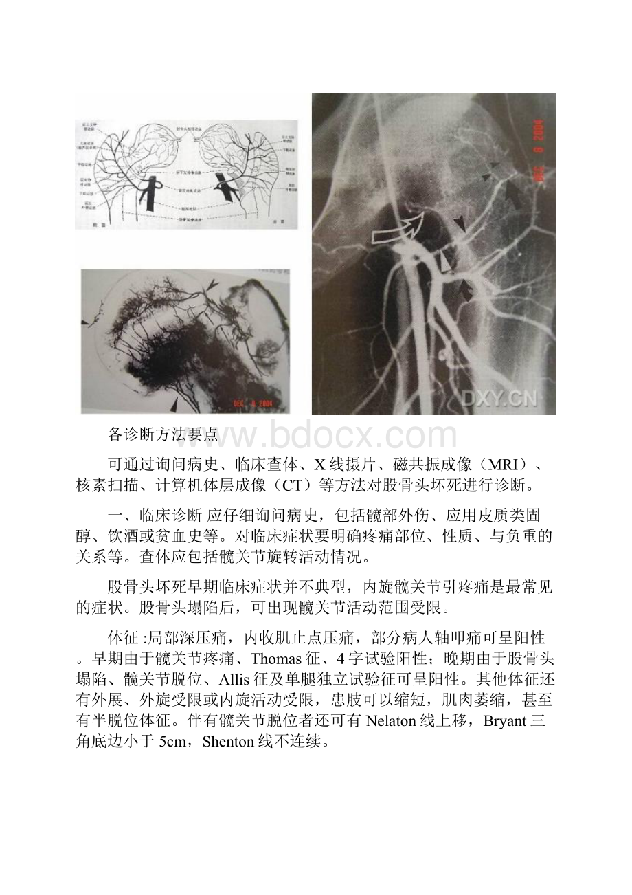 股骨头坏死.docx_第2页