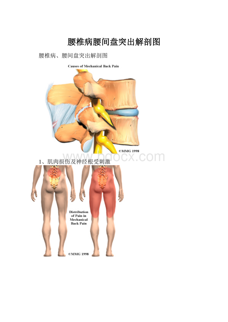 腰椎病腰间盘突出解剖图.docx