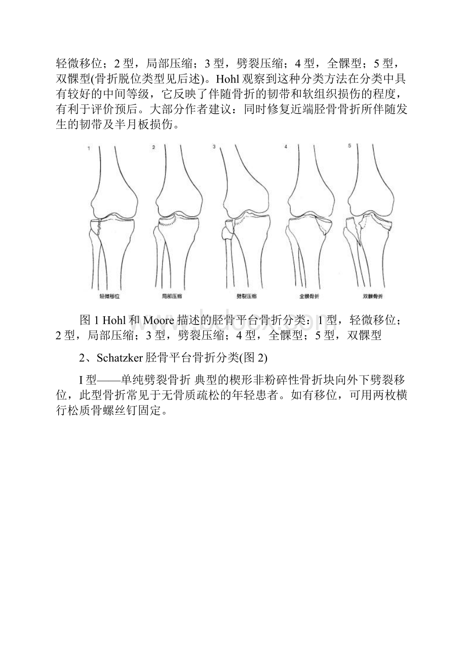 胫骨平台骨折解析.docx_第2页