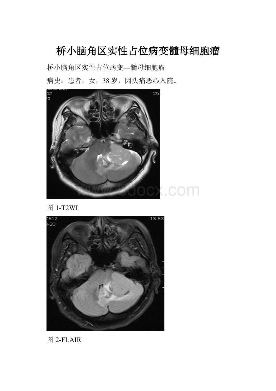 桥小脑角区实性占位病变髓母细胞瘤.docx