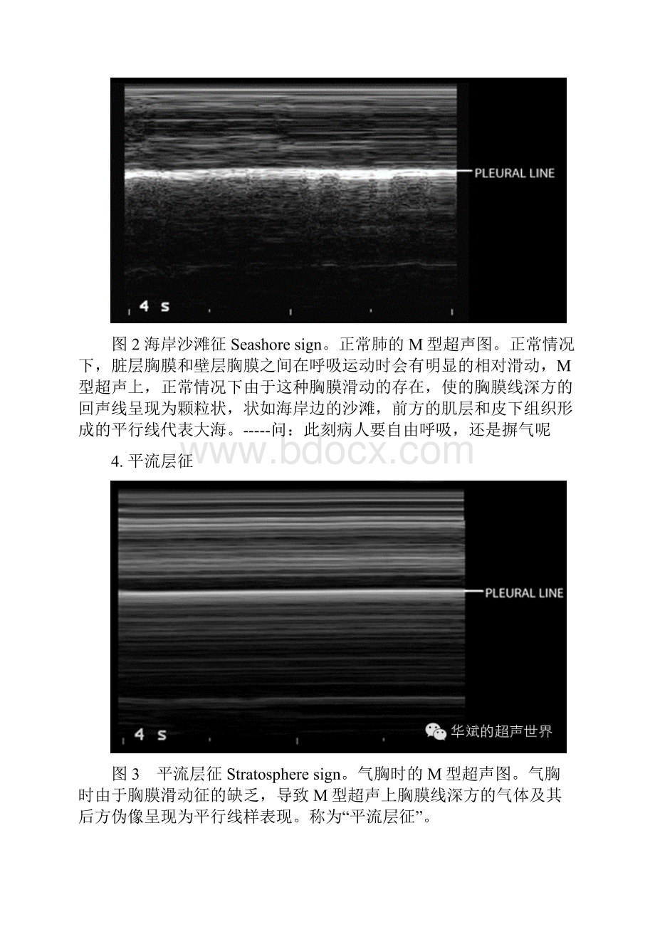 肺部超声一些常见形象征象解释.docx_第2页