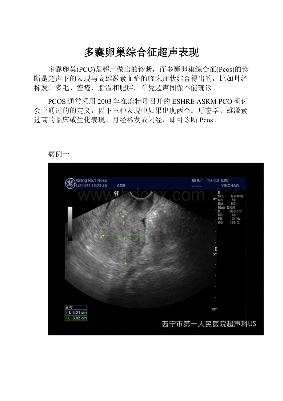 多囊卵巢综合征超声表现.docx