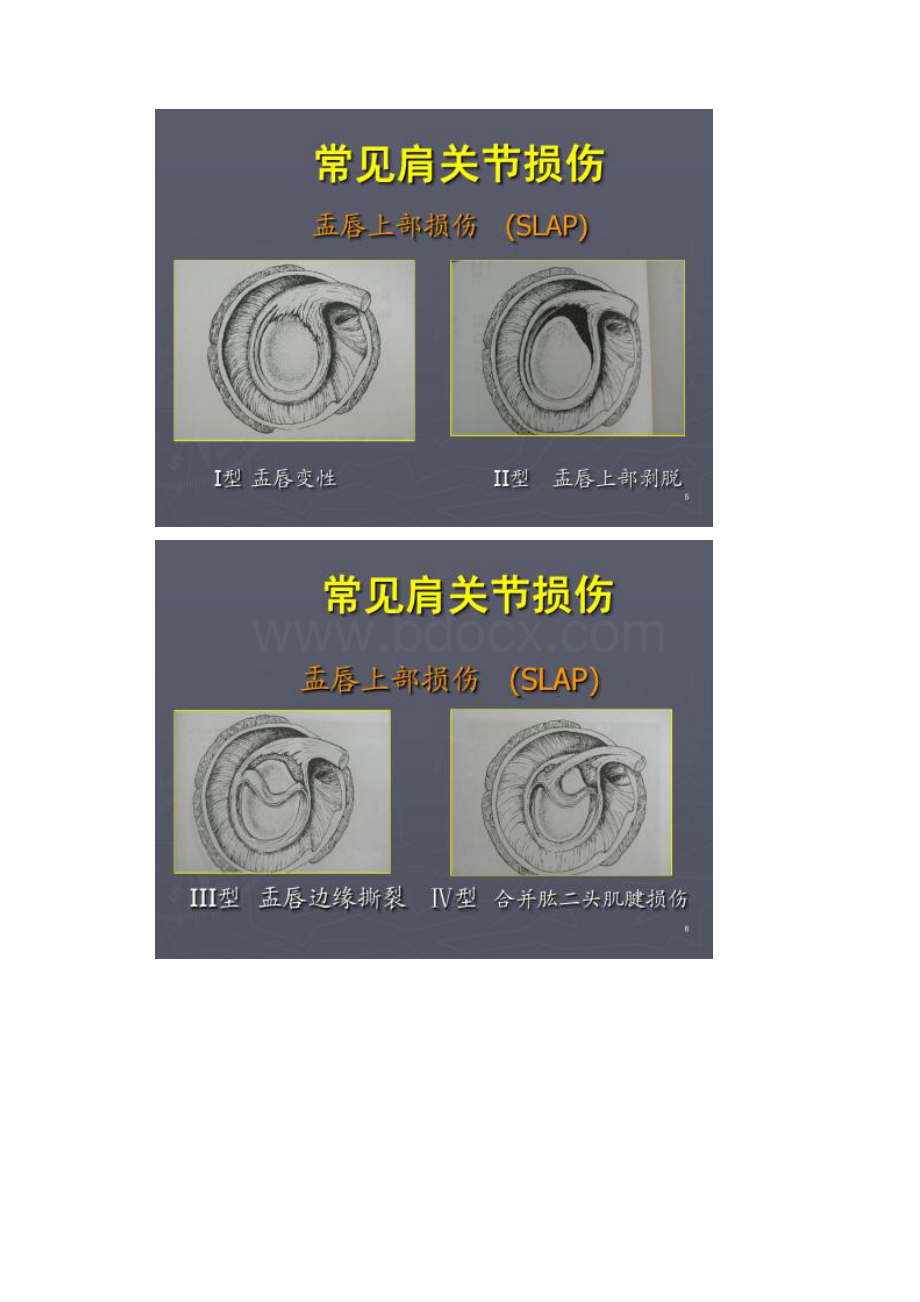 肩关节镜手术期护理要点概要.docx_第3页