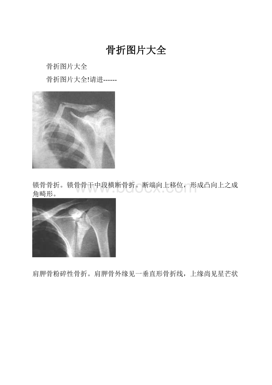 骨折图片大全.docx_第1页