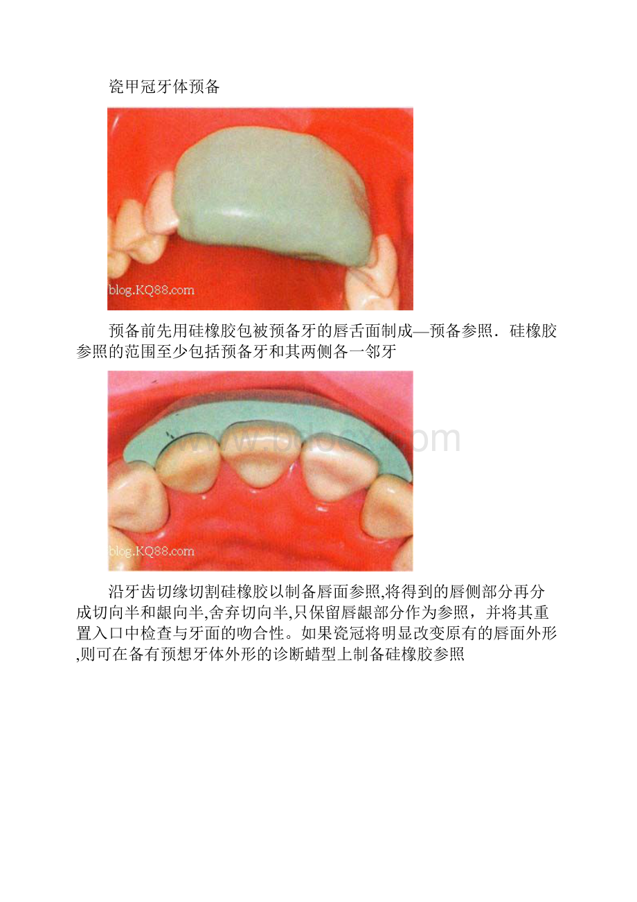 全瓷牙备牙方法图例.docx_第2页