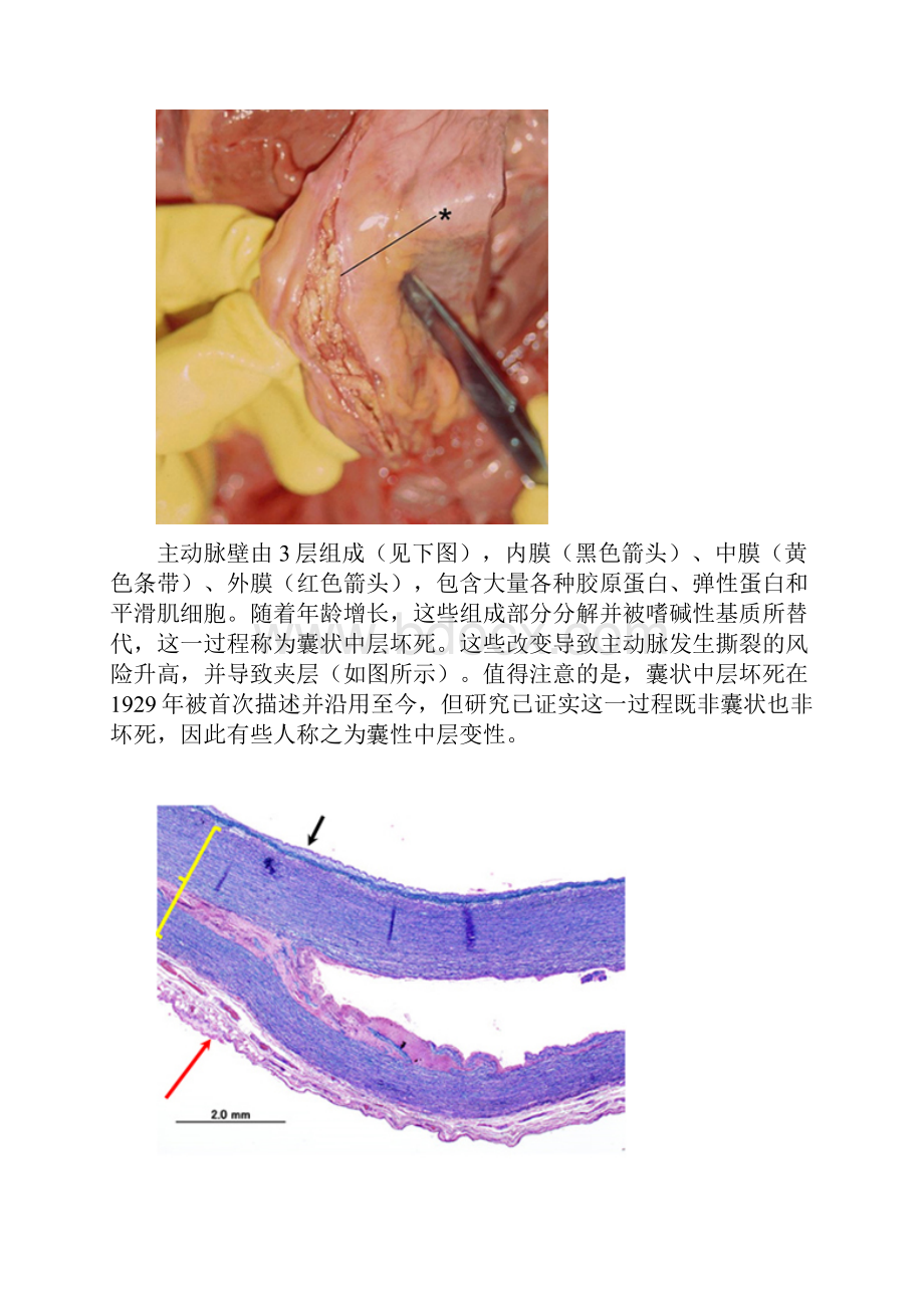 系统学习主动脉夹层讲解.docx_第2页