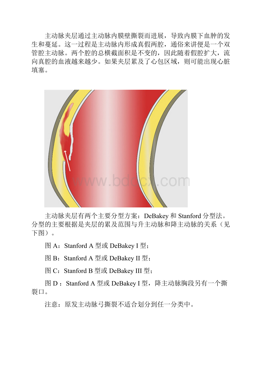 系统学习主动脉夹层讲解.docx_第3页