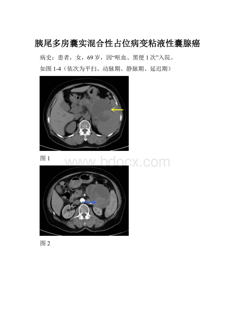 胰尾多房囊实混合性占位病变粘液性囊腺癌.docx