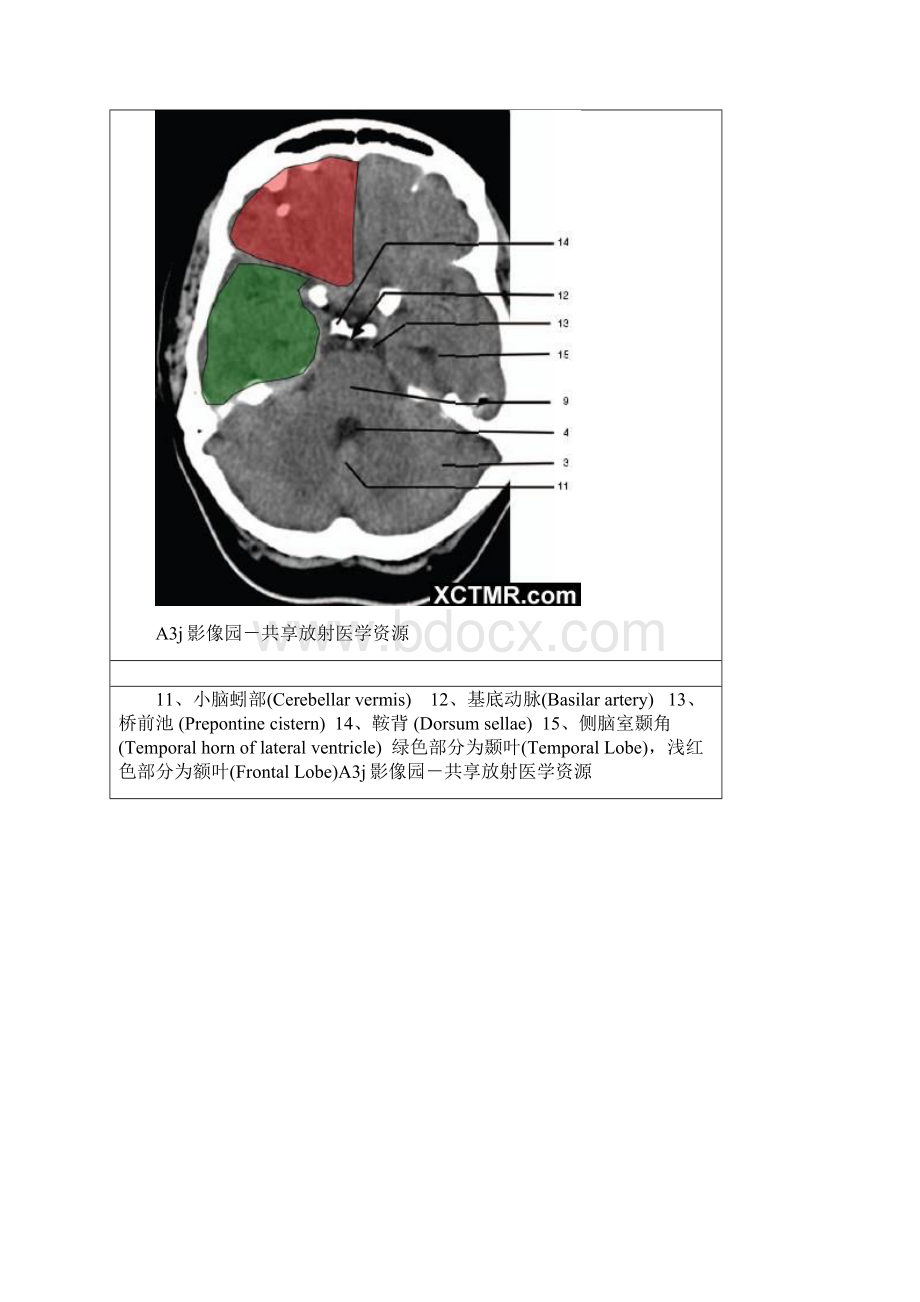 颅脑CT解剖 文档.docx_第3页