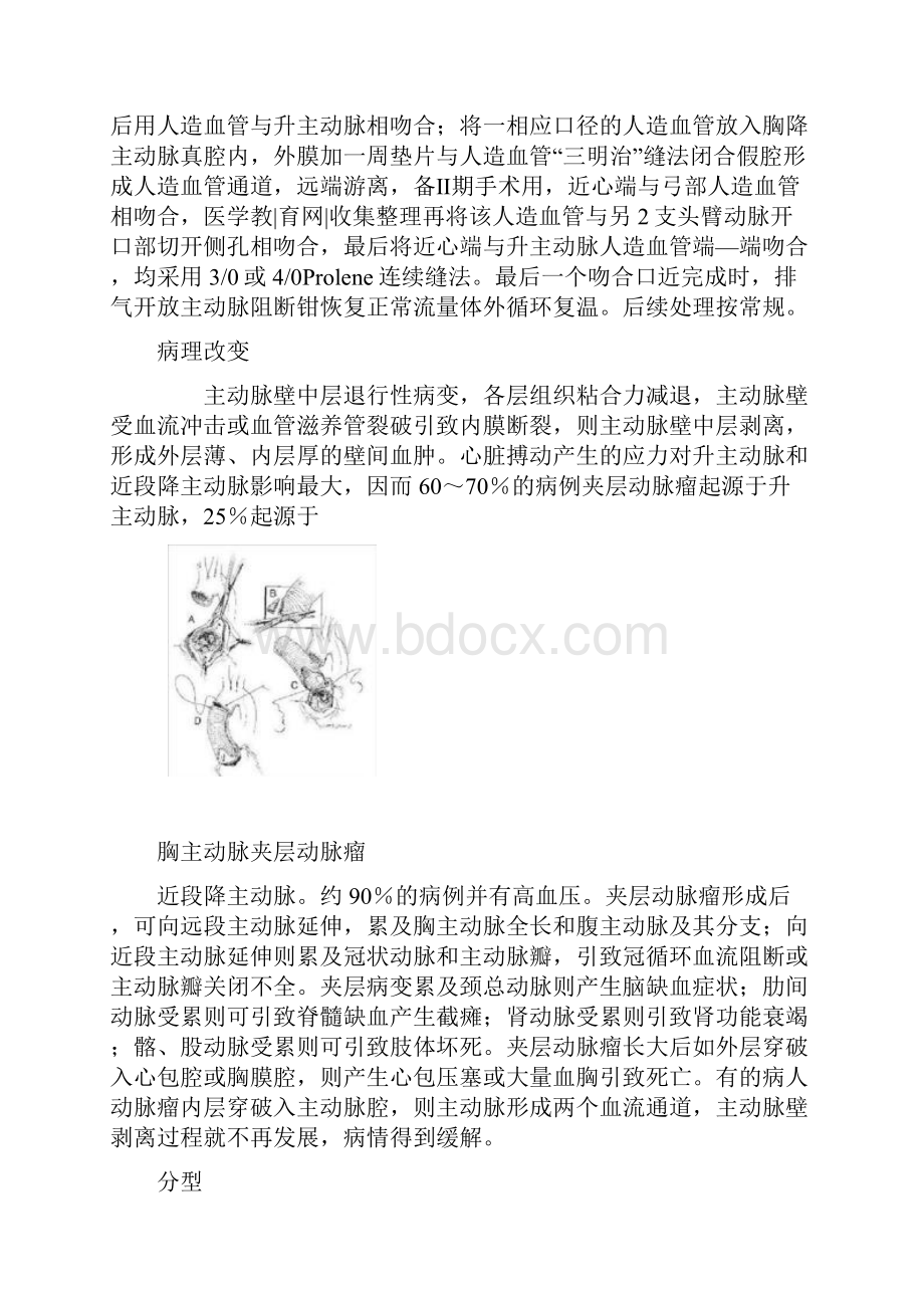 型夹层动脉瘤手术治疗.docx_第2页