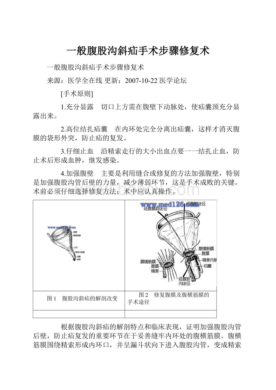 一般腹股沟斜疝手术步骤修复术.docx_第1页