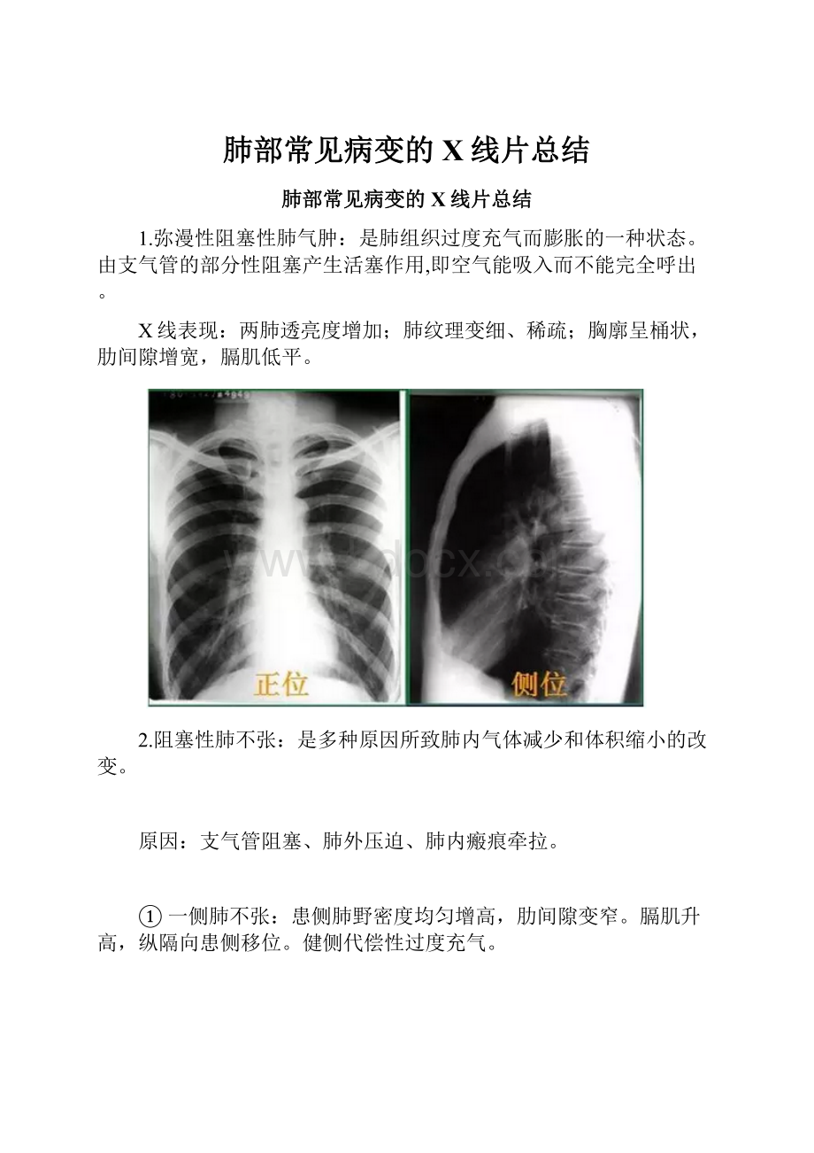 肺部常见病变的X线片总结.docx