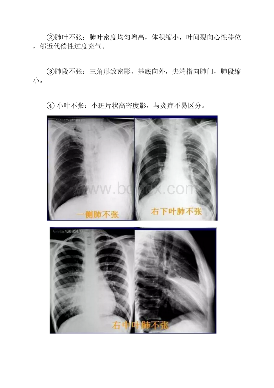 肺部常见病变的X线片总结.docx_第2页