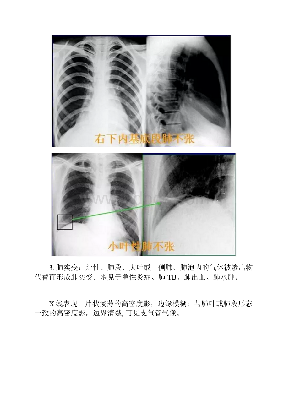 肺部常见病变的X线片总结.docx_第3页